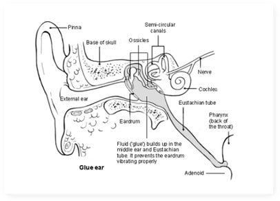 Glue Ear – Symptoms and Treatment